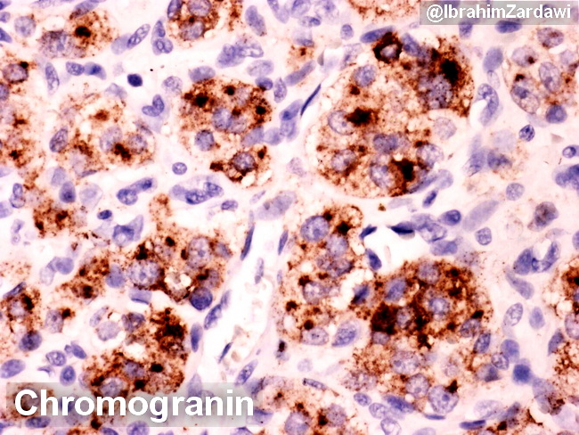 Carotid body tumour Chromogranin_IZ.jpg
